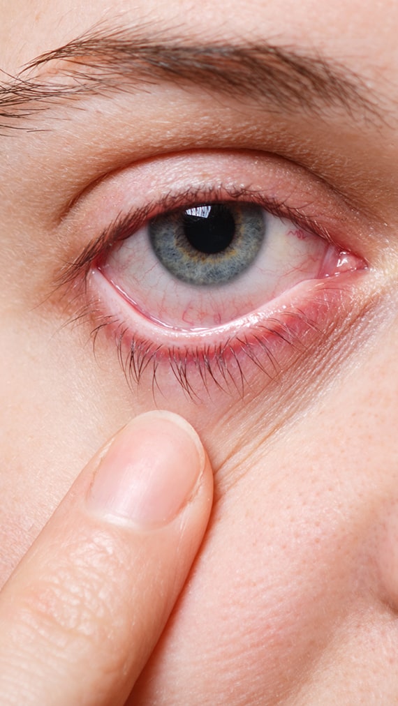 Qué es el síndrome del ojo seco (enfermedad del ojo seco)?